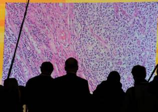 Cancer cure news updates 2016: U.K. scientists work on groundbreaking laser therapy for early stages of Prostate Cancer