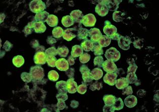 Girl dies from brain-eating amoeba in South Carolina; Mom comforted by thought of being reunited in heaven