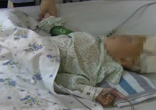 Boy Gets Chopstick Stuck Up Nose for 10 Days, Gets Brain Infection, Recovering After Undergoing Surgery