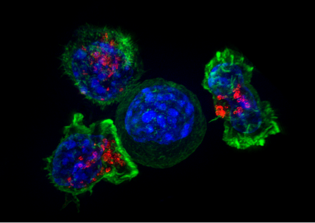 Cancer cure latest news update: Will a modified CAR-T cell treatment completely eradicate brain tumors?