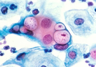 Cervical Cancer Test: New H.P.V. Test For Women Pushed Despite Medical Groups Rejection